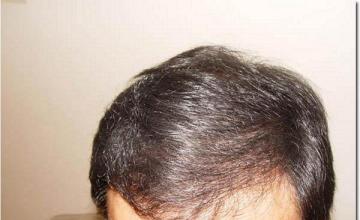 Hair restoration procedure results