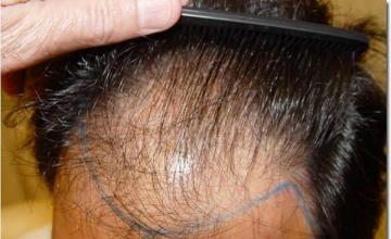 Hair restoration procedure results