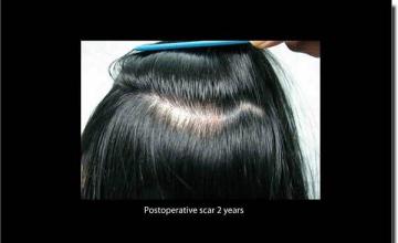 Hair restoration procedure results