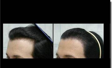 Hair restoration procedure results