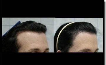 Hair restoration procedure results