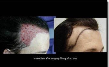 Hair restoration procedure results