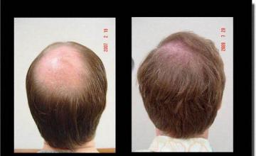 Hair restoration procedure results