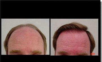 Hair restoration procedure results