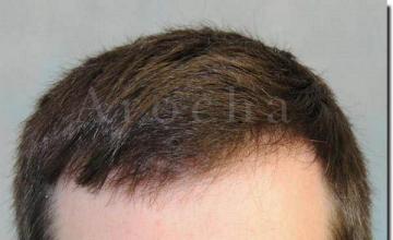 Hair restoration procedure results