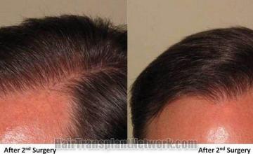 Closeup views of hairlines after hair restoration