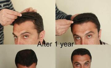 Hair restoration procedure before and after result photographs