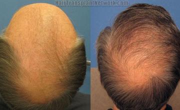 Patient crown photos before and after hair replacement