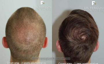 Hair restoration procedure before and after pictures,