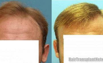 2416 graft front view before and after hair transplant