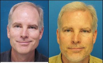 Hair restoration procedure before and after results