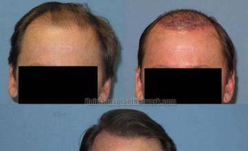 Hair restoration procedure before and after results