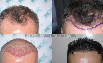 Hair restoration procedure before and after results