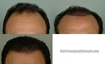 Hair restoration procedure before and after results