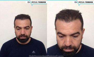 Before and after hair transplant procedure images