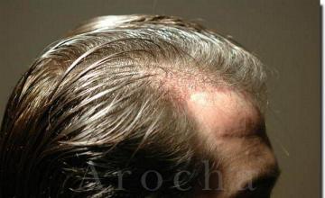 Hair restoration procedure results