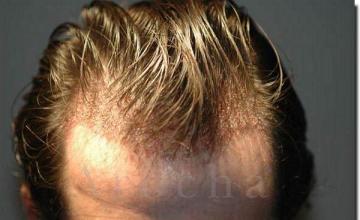 Hair restoration procedure results