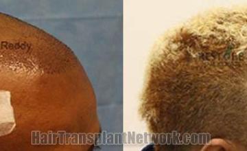 Hair transplantation surgery before and after images