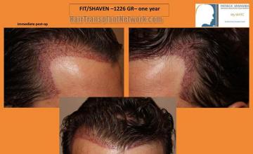 Hair restoration procedure before and after pictures