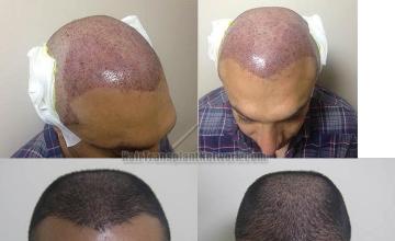 Hair restoration procedure before and after pictures