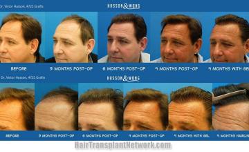 Hair transplant surgery before and after photos