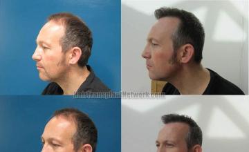 Hair transplantation surgery before and after pictures