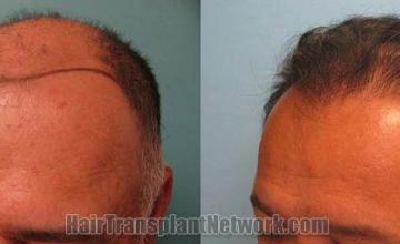 Hair restoration procedure before and after pictures