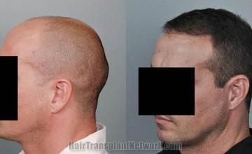 Hair transplantation surgery before and after pictures