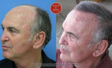 Hair transplantation surgery before and after pictures