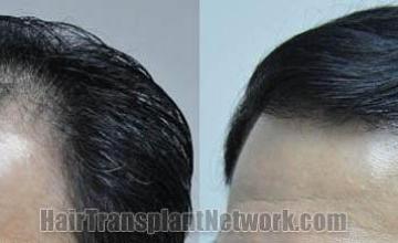 Hair transplantation surgery before and after pictures