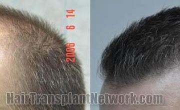 Hair transplantation surgery before and after images