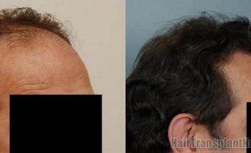 Hair replacement  - Before and after right side