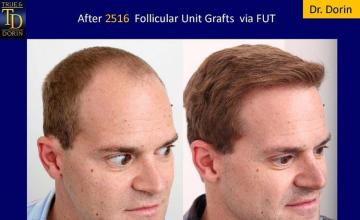 Hair transplantation surgery before and after images