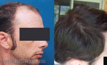 Hair restoration procedure before and after pictures