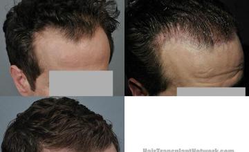 Hair transplantation surgery before and after images