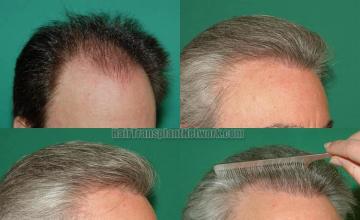 Hair transplantation surgery before and after images