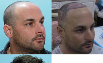 Hair transplantation surgery before and after photos