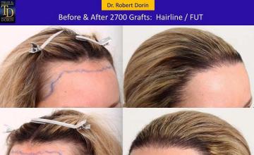 Hair transplantation surgery before and after pictures