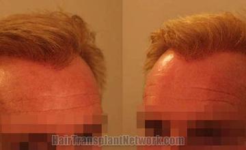 Hair transplantation procedure before and after 