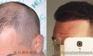 Hair transplantation surgery before and after images