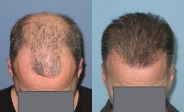 Hair restoration surgery before and after images