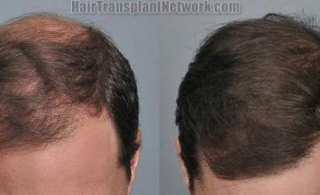 Hair transplantation surgery before and after pictures