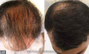 Before and after hair transplant procedure images