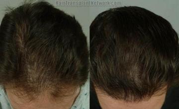 Hair restoration procedure before and after results