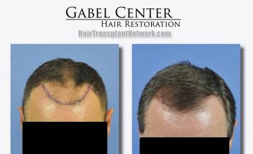 Hair restoration procedure before and after results