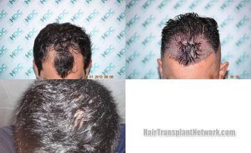 Hair transplantation surgery before and after photos