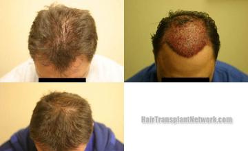 Hair transplantation surgery before and after photos