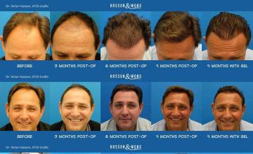  Before and after hair transplant surgery result images