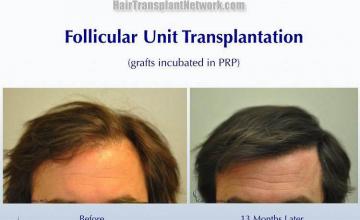 Hair restoration procedure before and after results