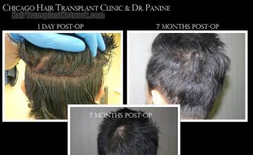 Hair transplantation surgery before and after pictures